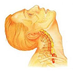 Osteochondrose vun der Halswirbelsäule