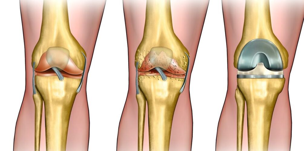 Arthrosis vum Knéi Gelenk