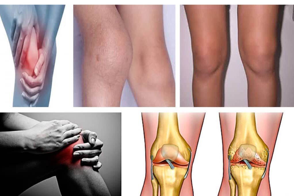Symptomer vun Arthrosis vum Knéi